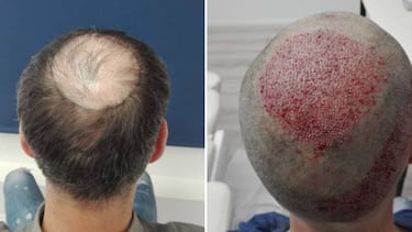 Clattenburg se somete a un trasplante de cabello: "Me sentía frustrado"